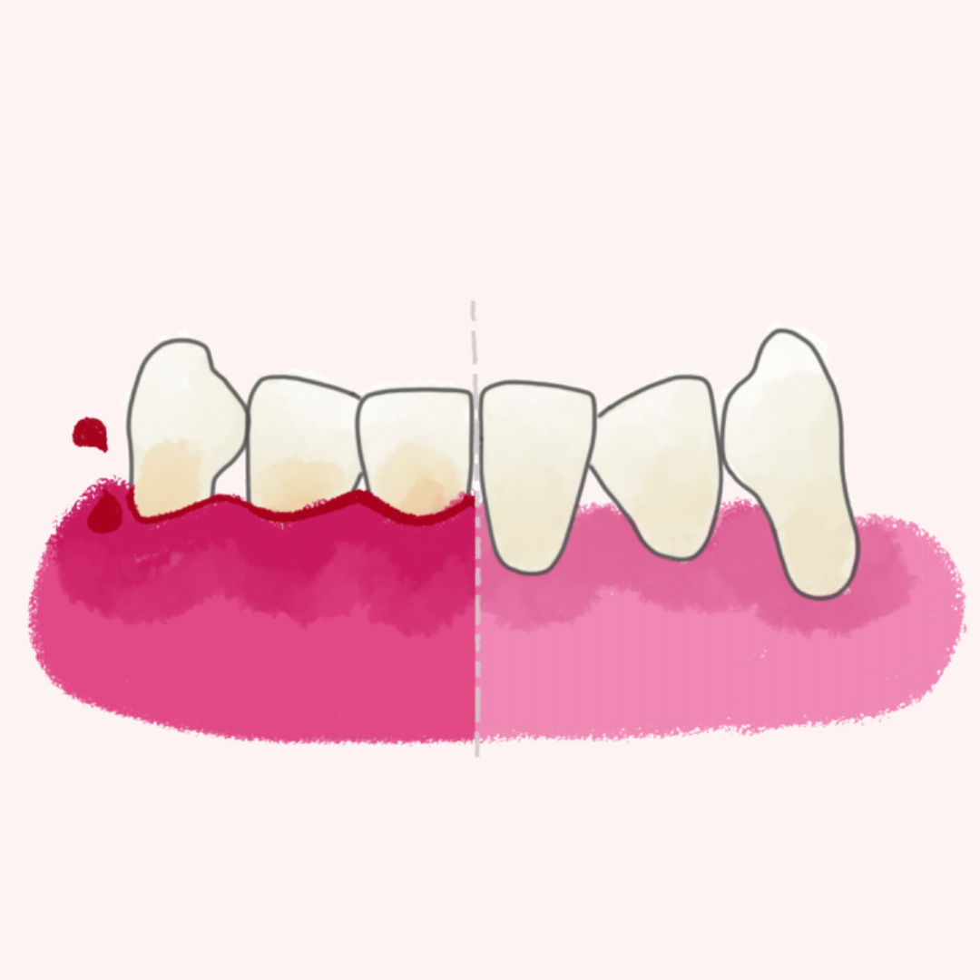 Gingivitis