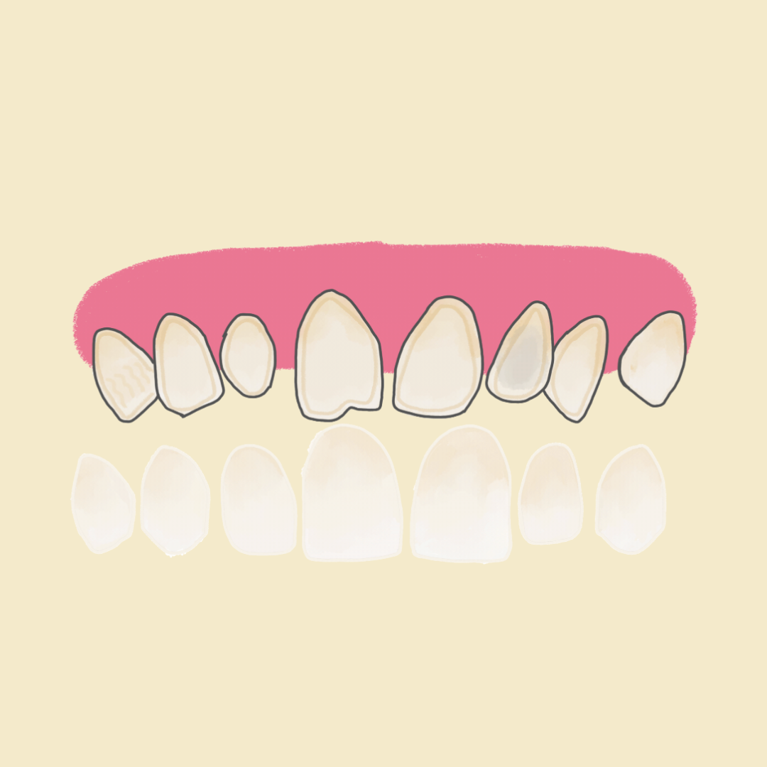 Carillas Dentales