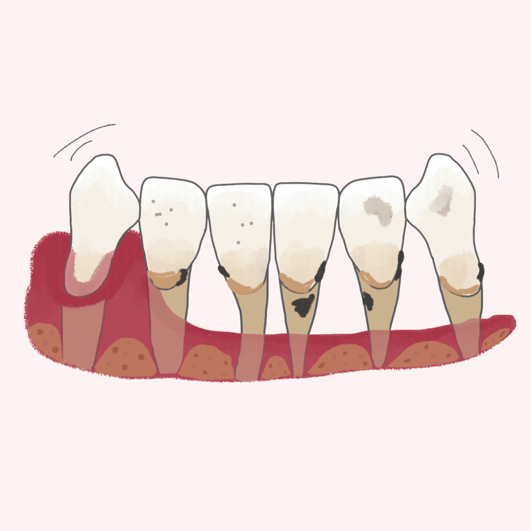 Periodontitis