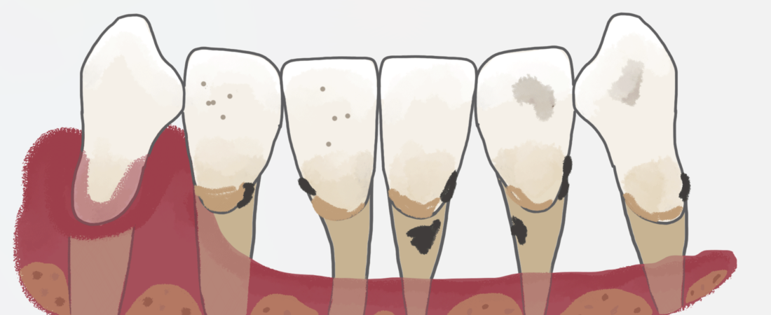 Periodontitis