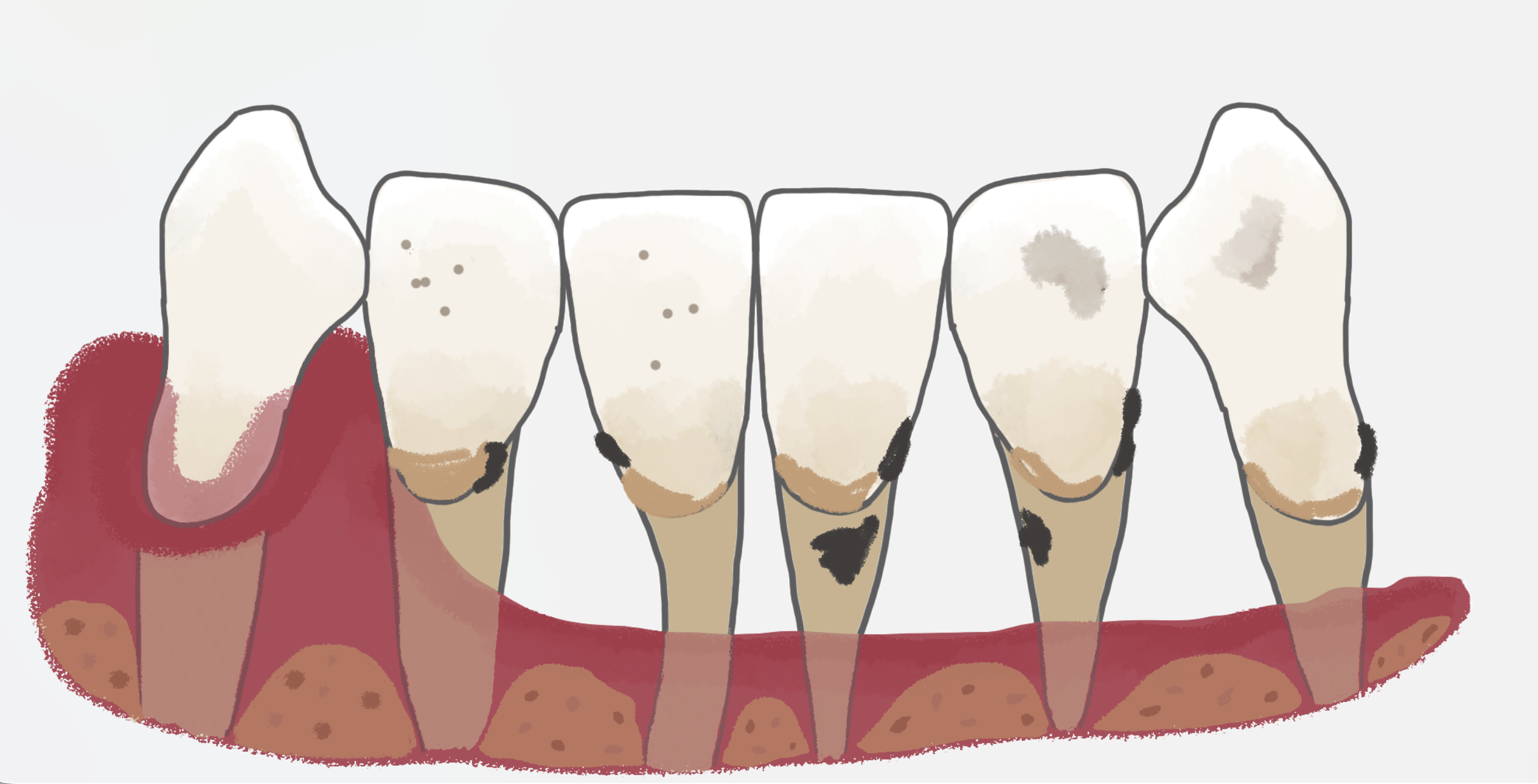 Periodontitis