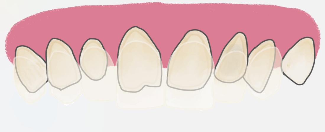 Carillas Dentales