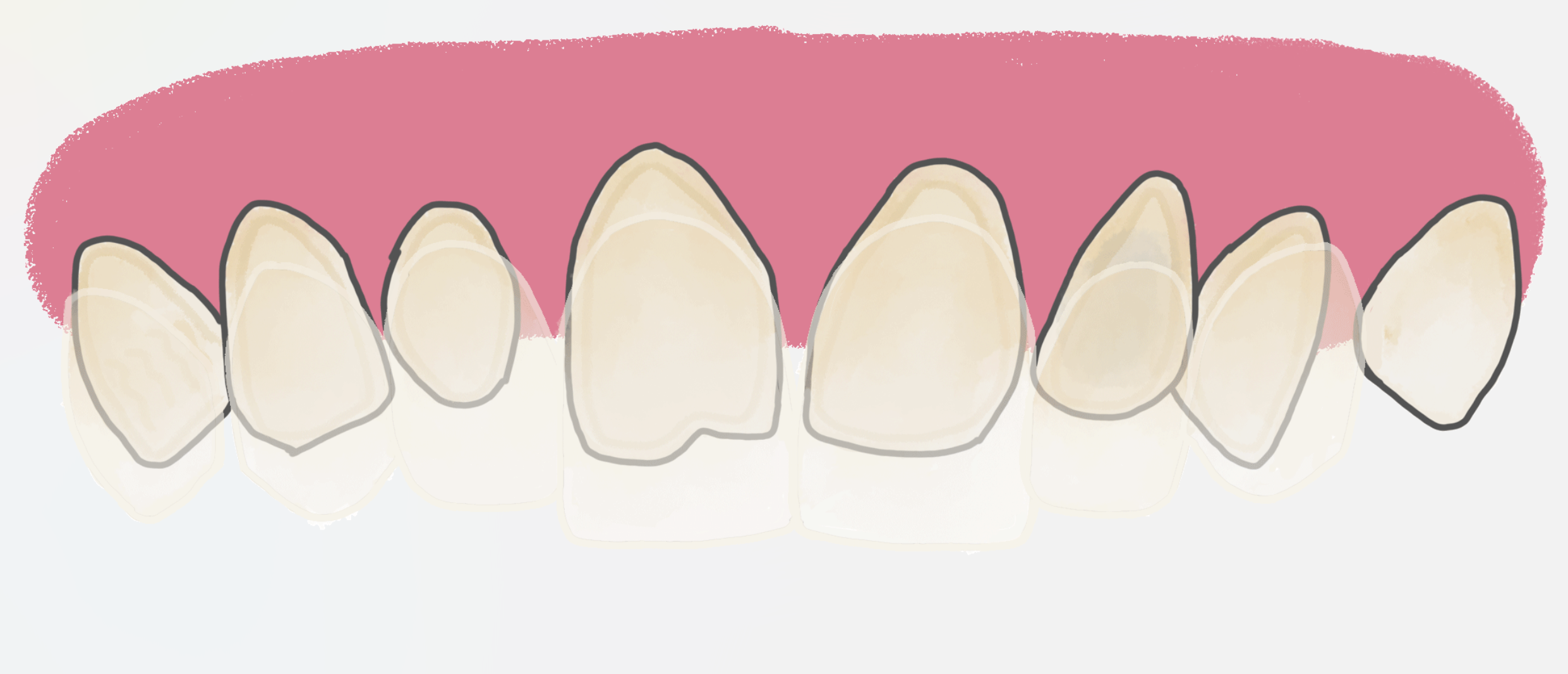 Carillas Dentales