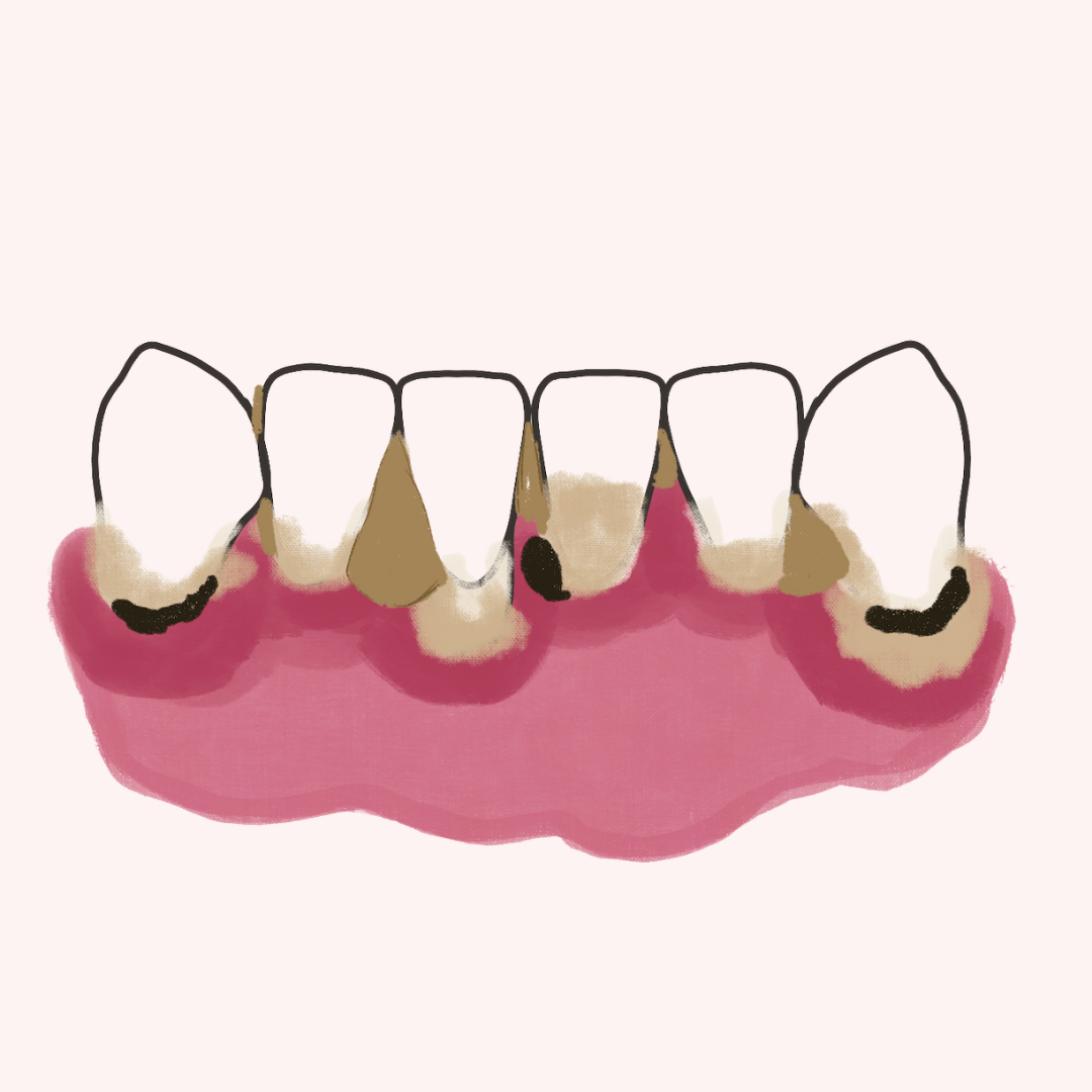 ¿Placa Bacteriana y sarro son lo mismo? Biopelicula y cálculos dentales
