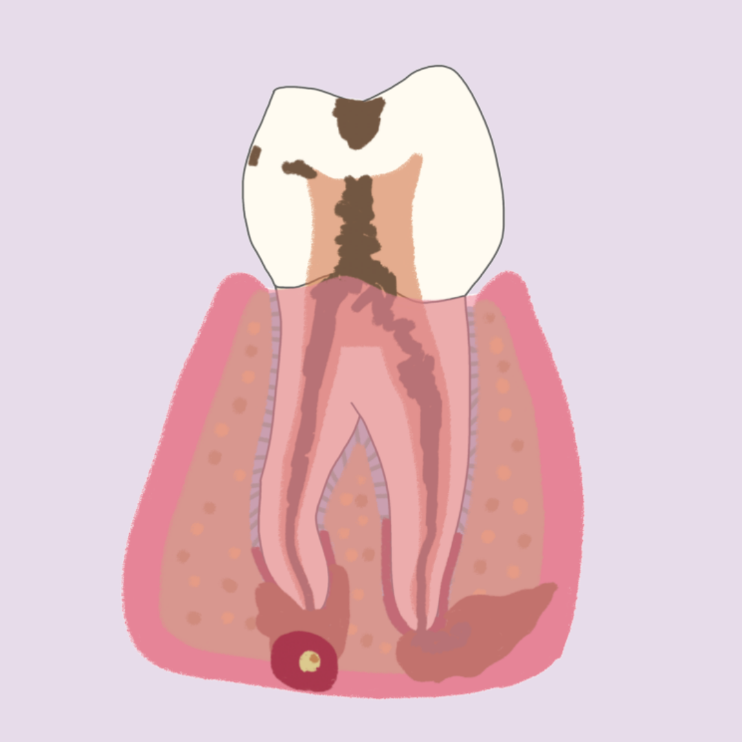 Absceso periapical