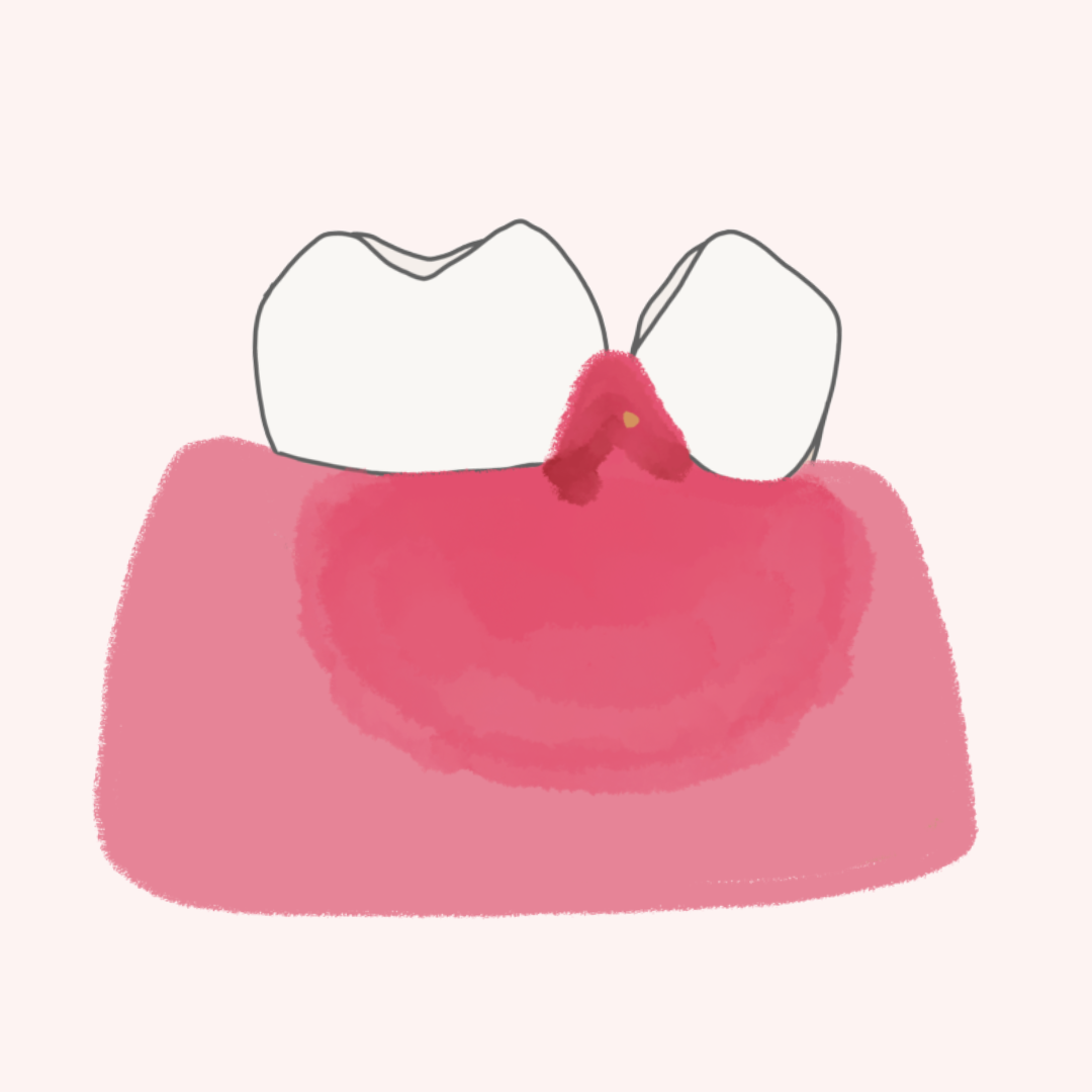 Absceso periodontal