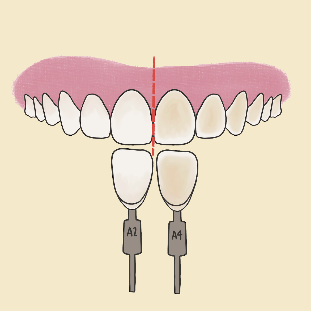 Blanqueamiento dental