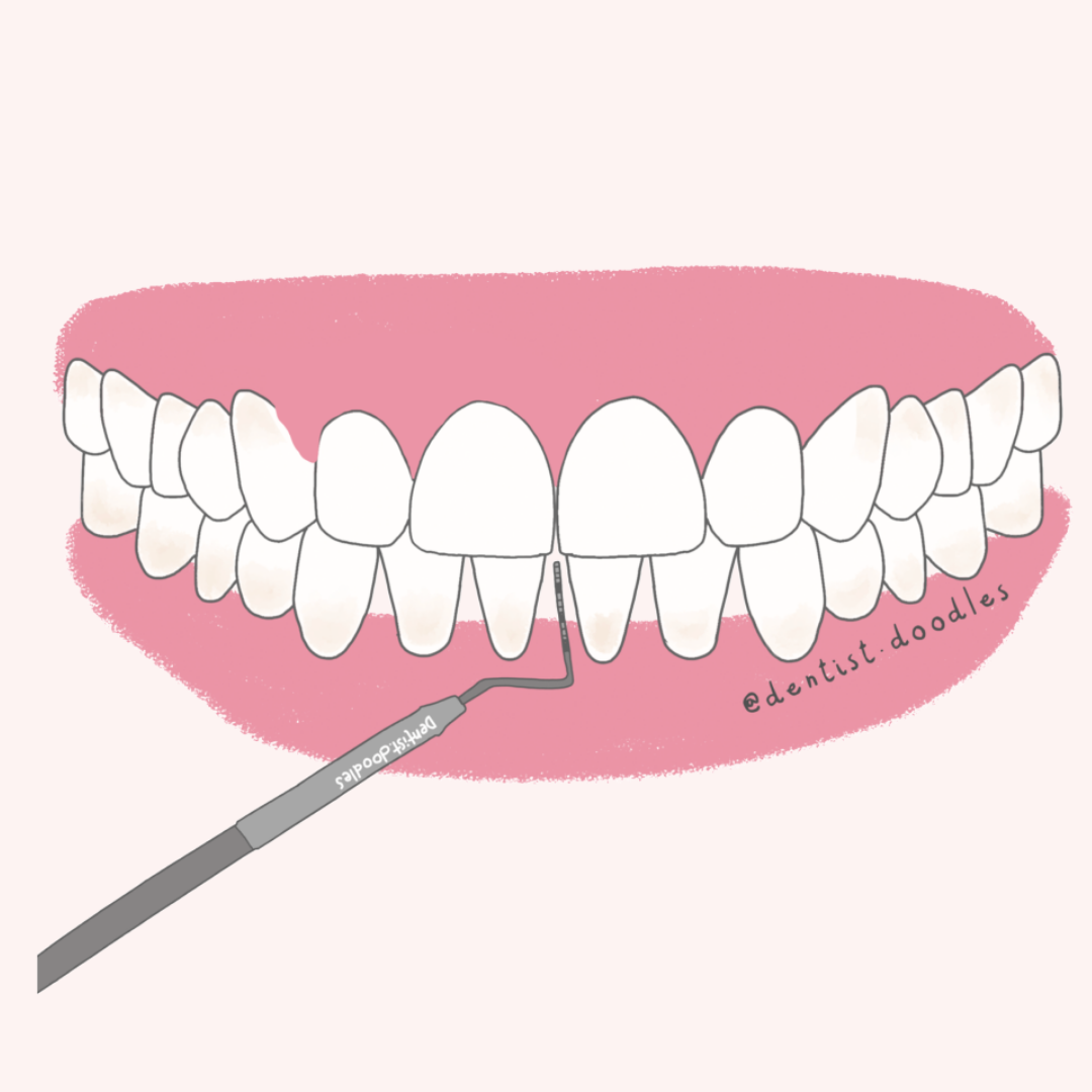 Bolsas periodontales