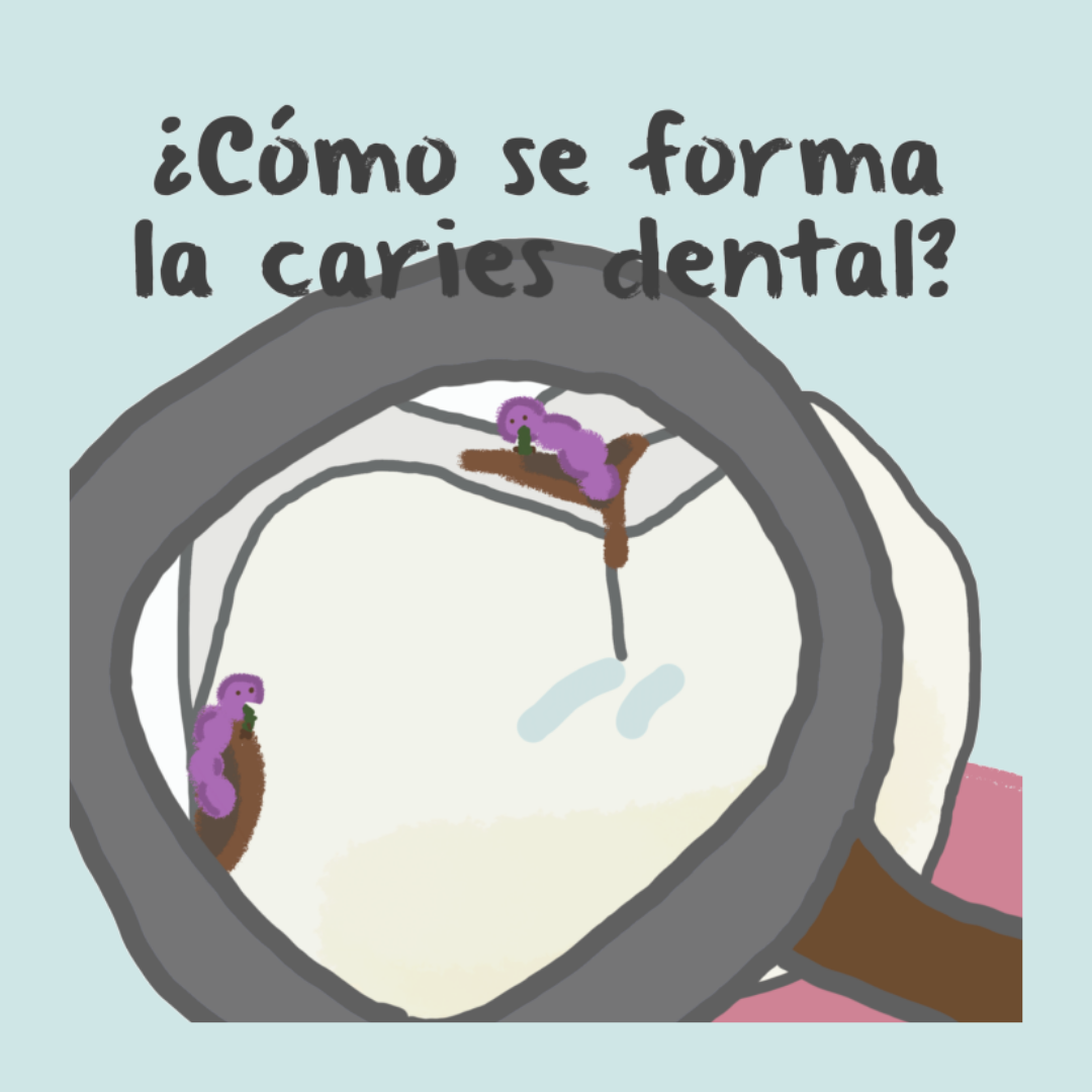 ¿Cómo se forma la caries dental?