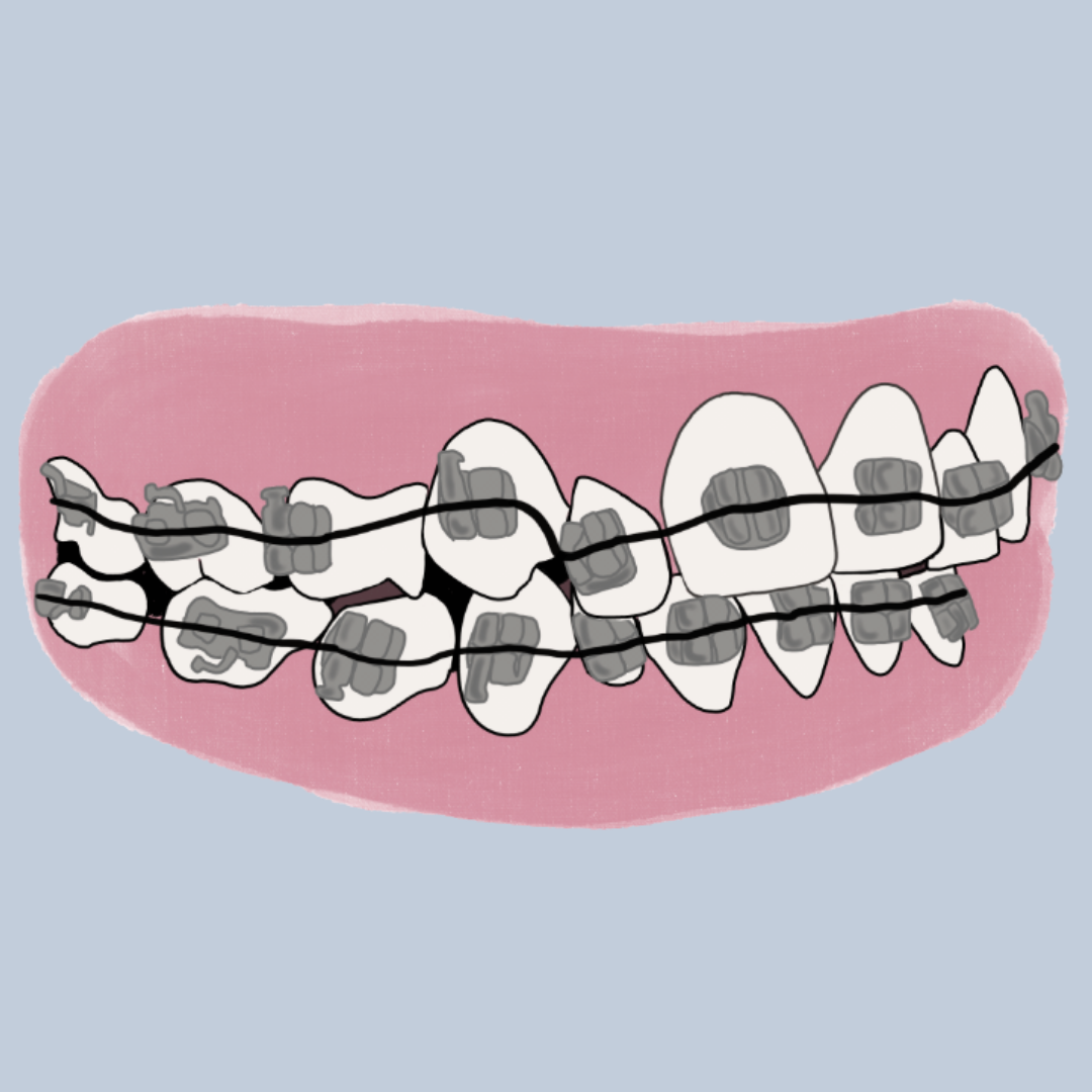 ¿Cómo se mueven los dientes?