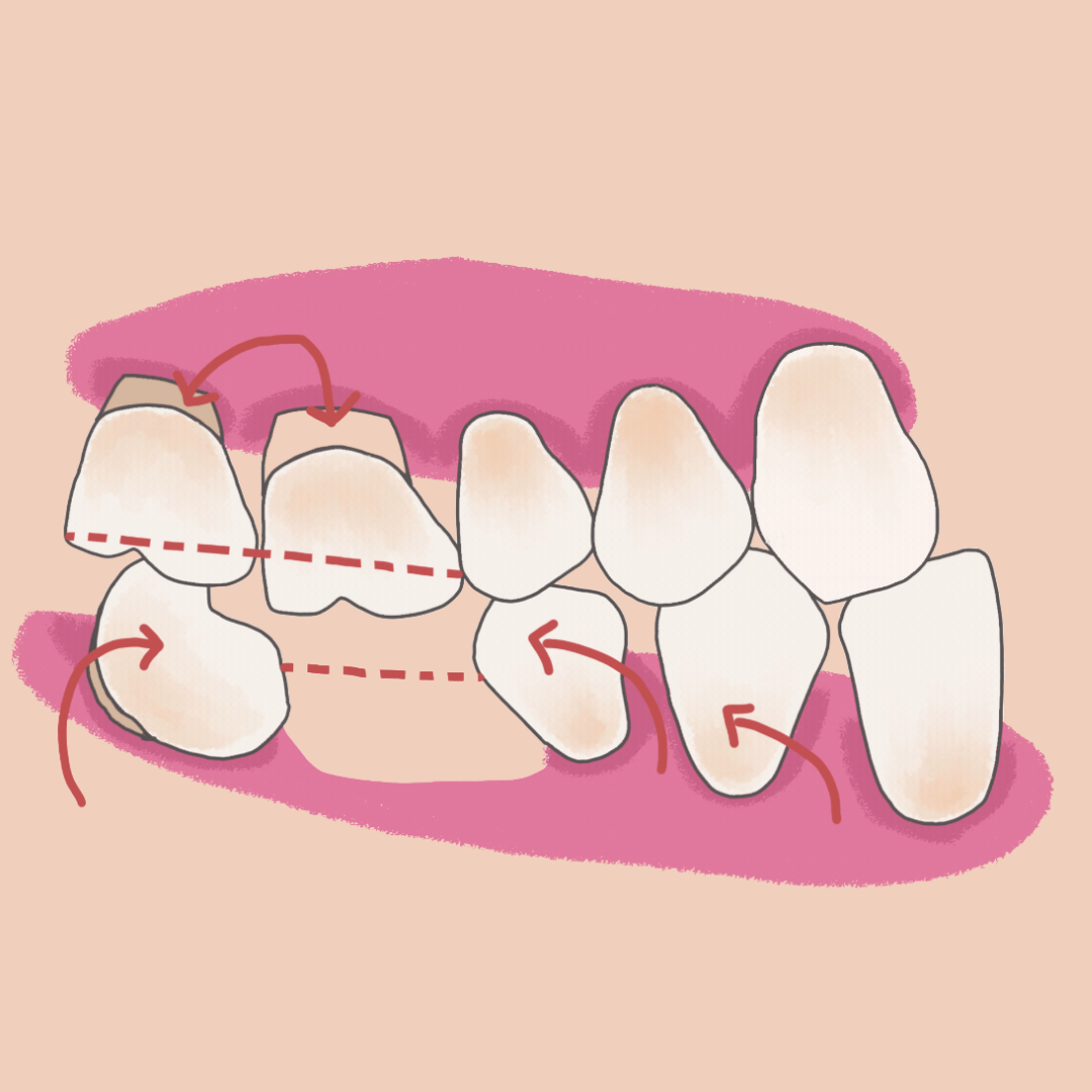 Consecuencias de la pérdida dental