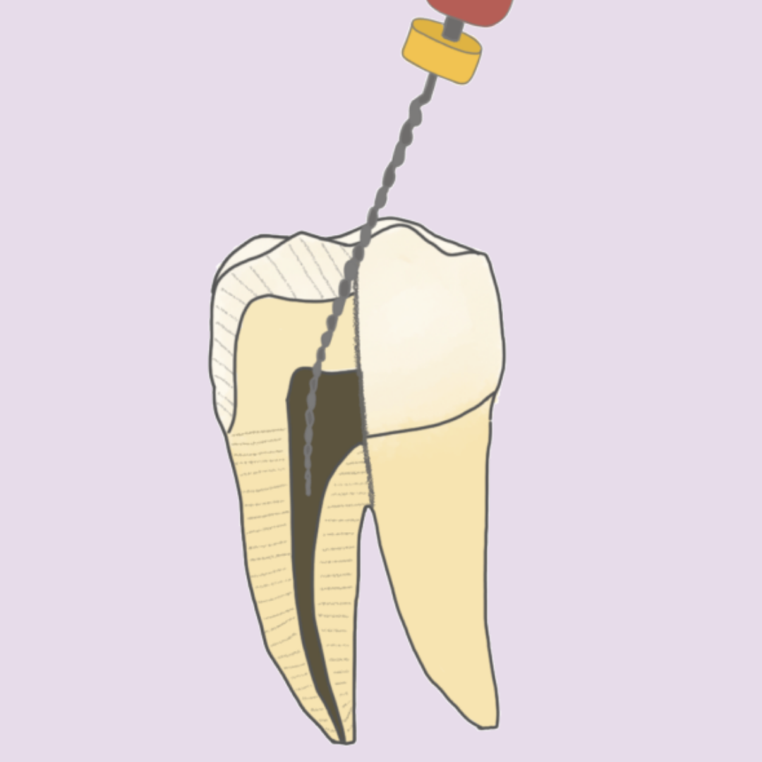 ¿Cuándo se realiza una endodoncia?