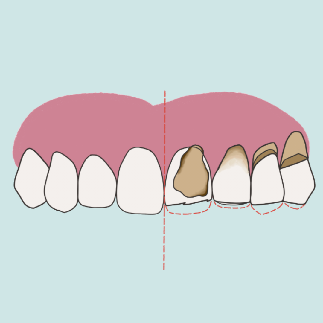 Lesiones dentales NO cariosas
