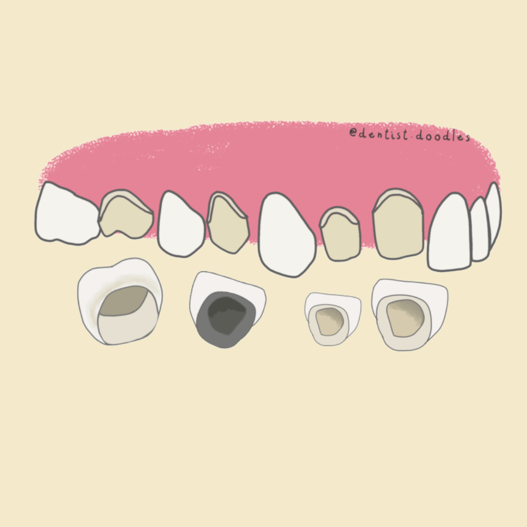 Materiales de coronas dentales
