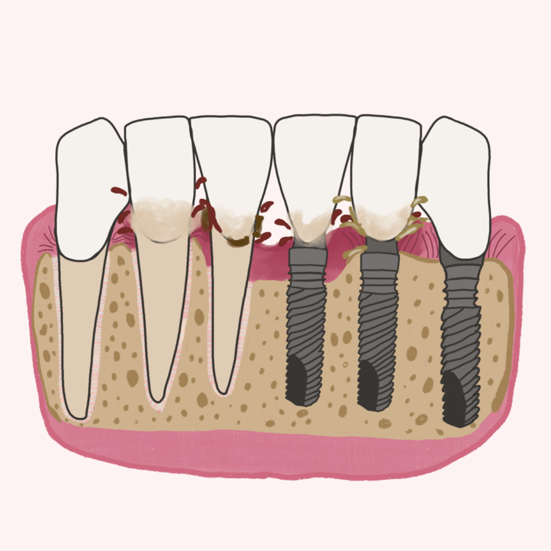 Enfermedades periodontales y periimplantares