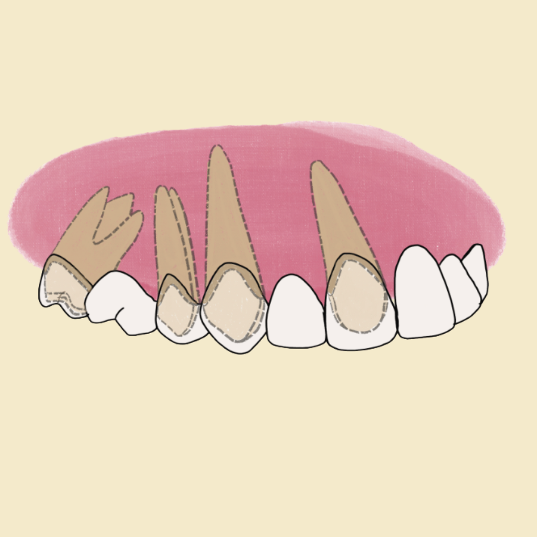 Puentes dentales