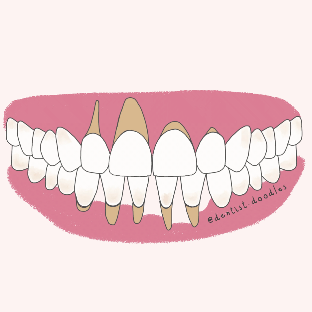 Recesión gingival