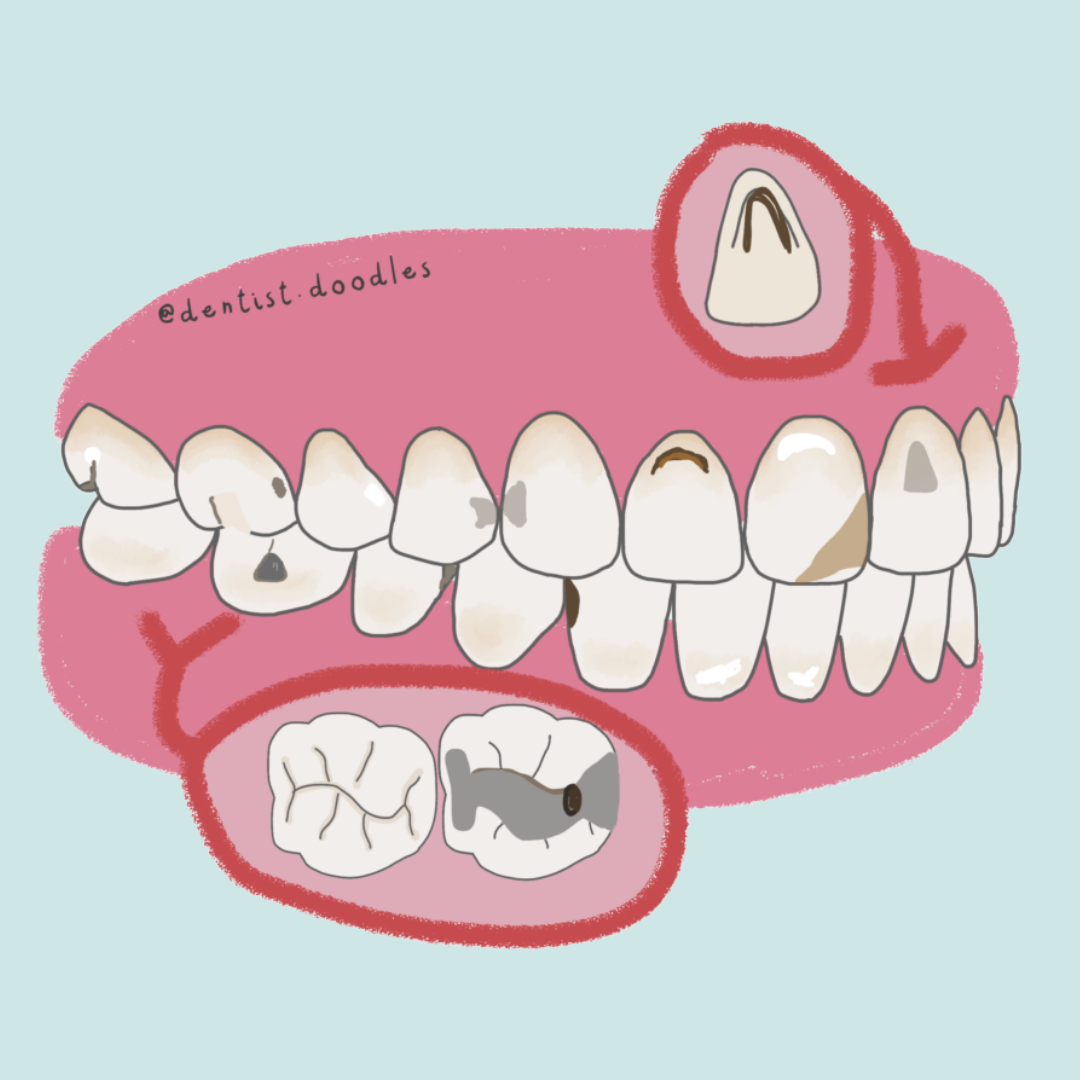 Tipos de caries